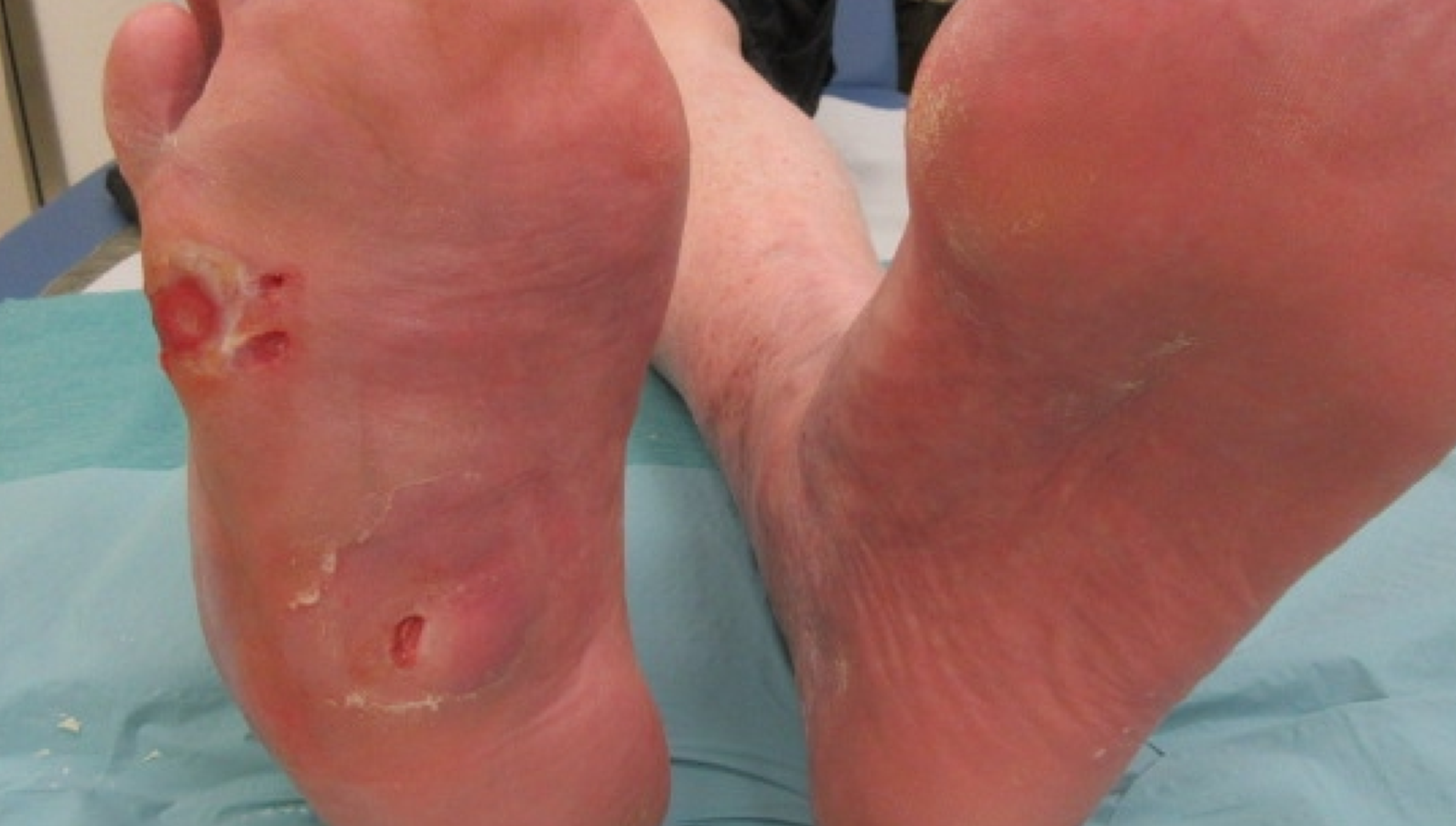 Bone Infection Treatment